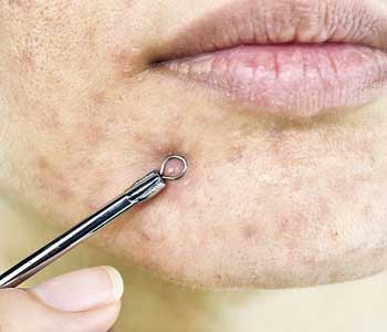 Acne Scars Laser Treatments from Jupiter, FL dermatologist